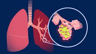 Understanding Pneumococcal Pneumonia [upl. by Aspasia]