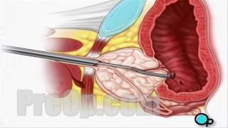 TURP Transurethral Resection Prostate Surgery patient education series [upl. by Chang]