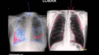 Pneumonia Imaging [upl. by Vala]