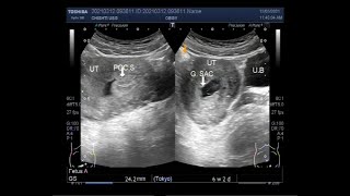 Ultrasound Video showing Incomplete abortion [upl. by Sylado]