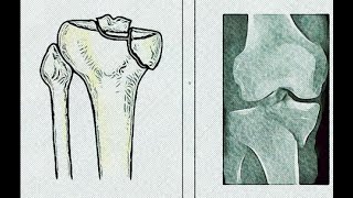 Atlantoaxial Rotary Instability Findings and Treatment Outcomes Research  Dr Fraser Henderson [upl. by Lon347]