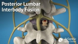 Posterior Lumbar Interbody Fusion PLIF [upl. by Zales]