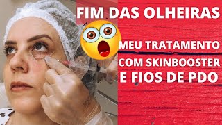 TCHAU OLHEIRAS TRATAMENTO COM SKINBOOSTER E FIOS DE PDO NA PELE MADURA [upl. by Garges561]