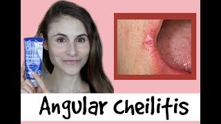 Angular cheilitis causes amp treatments a QampA with dermatologist Dr Dray [upl. by Inwat]