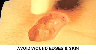 Enzymatic Debridement Demonstration Understand Wound Care [upl. by Ihcekn]