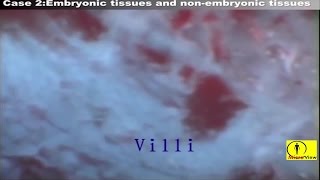 Abortion MTP Video MTP Procedure [upl. by Amice32]