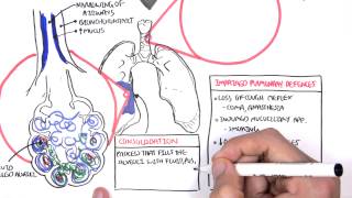 PART I  Pneumonia Overview Lobar and Bronchopneumonia [upl. by Aylat527]