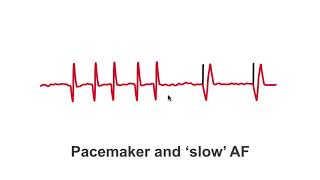 Pacemakers and quotslowquot AF patients [upl. by Lyndon]