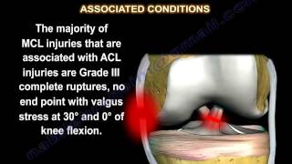 Slocum Test  Anterolateral Rotatory Instability ALRI of the Knee [upl. by Wyatt428]