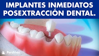 Implantes dentales inmediatos posextracción dental © [upl. by March]