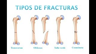 Tipos de Fracturas [upl. by Elletnwahs]