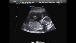 Baby girls ultrasound at 19 weeks [upl. by Bianka]