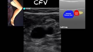 POCUS  Lower Extremity Deep Venous Thrombosis DVT  Updated [upl. by Ritter898]