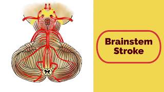 Brainstem Stroke Syndromes [upl. by Silrak]