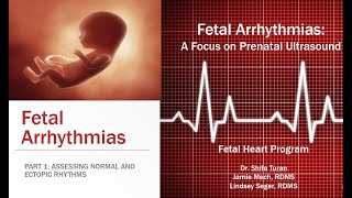 FETAL ARRHYTHMIAS Part One  Assessing Normal and Ectopic Rhythms [upl. by Otxis]