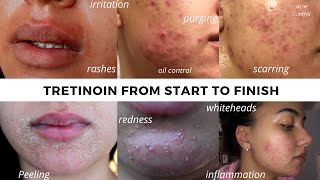 TRETINOIN BEFORE AND AFTER  FULL TRETINOIN EXPERIENCE my journey from start to end Adult Acne [upl. by Aivat881]