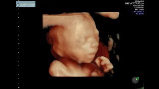 20 week ultrasound [upl. by Sully]