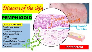 Pemphigoid Causes pathogenesis Types Histopathology Treatment  Pemphigus vs Pemphigoid [upl. by Angeli148]