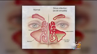 Doctor Tried And True Methods For Sinus Relief Are Still Best [upl. by Annecorinne614]