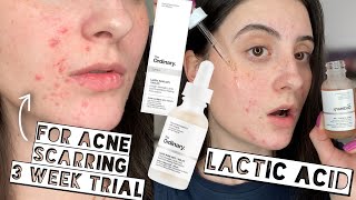 TESTING THE ORDINARY LACTIC ACID 10  HA ON ACNE SCARS FOR 3 WEEKS  Sensitive  Dry Skin [upl. by Darrick603]